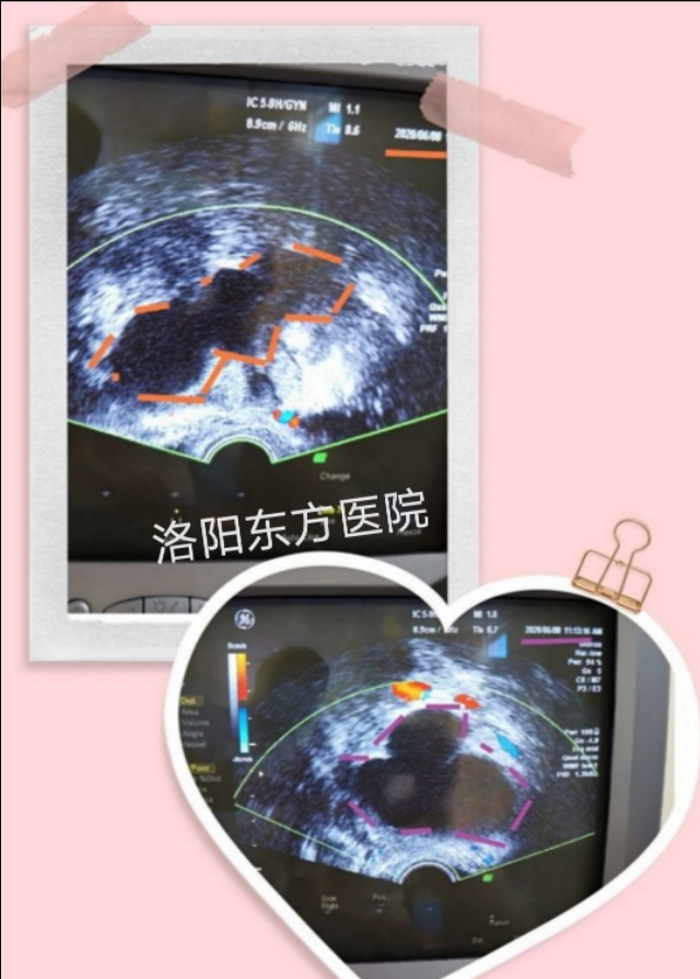 盆腔囊肿要复查吗,盆腔囊性占位灶建议复查