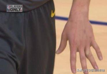 打球手臂脱臼后多久能恢复,打球手指脱臼怎么进行康复训练