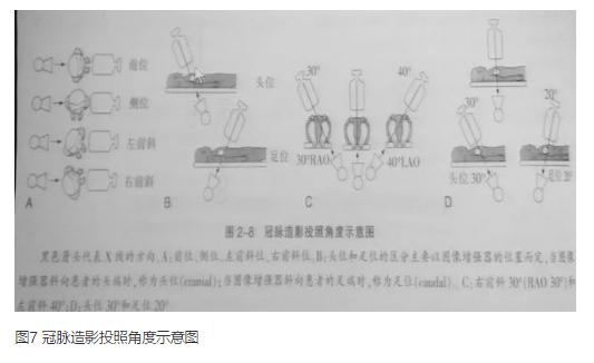 清晰完整揭秘冠脉造影全部过程,冠脉造影教学视频