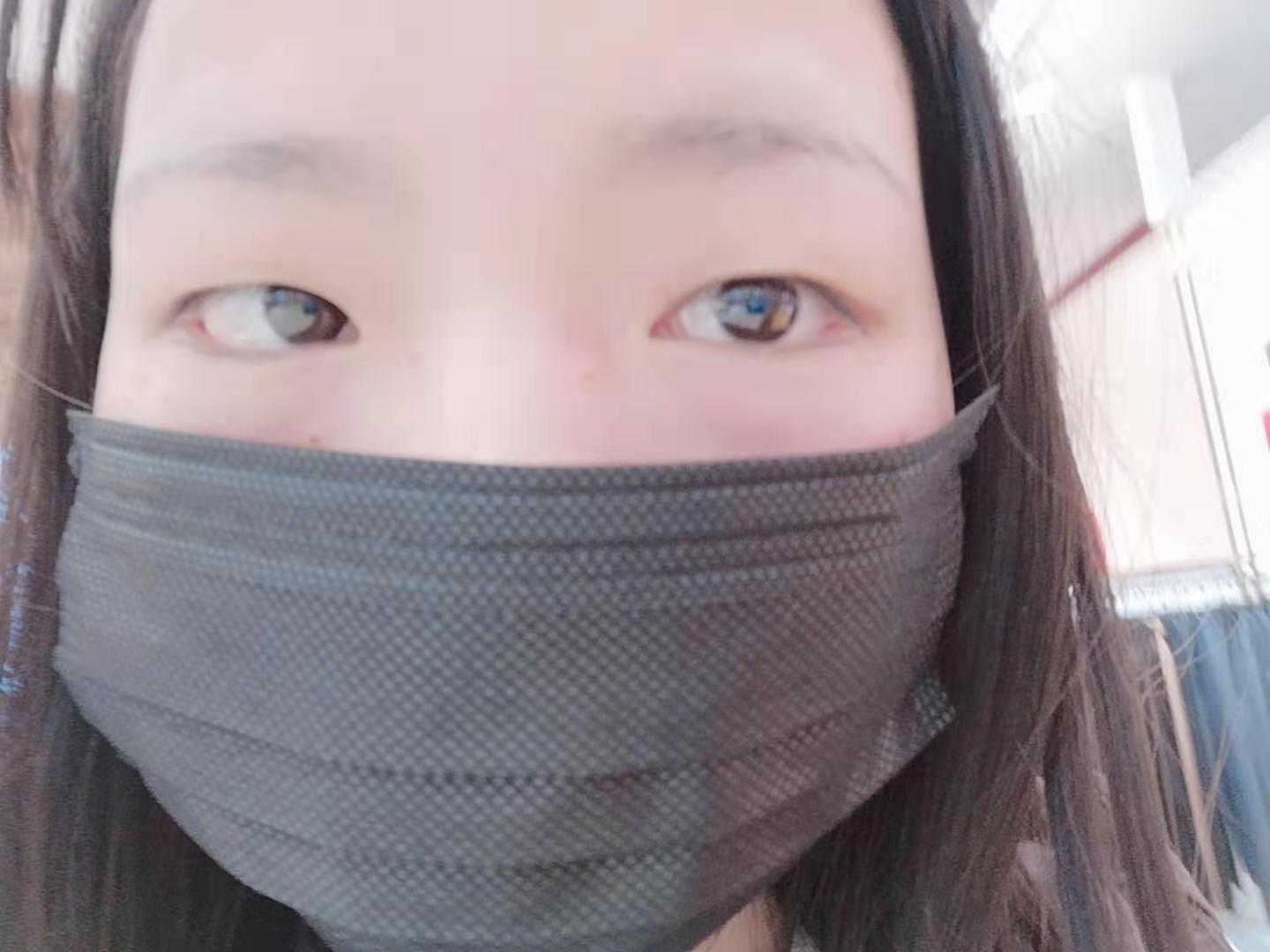 点痣点斑半年心路历程分享,点痣点斑膏真的有效果吗