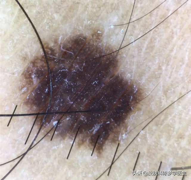 脸上长很多痣是好还是坏,脸上痣发炎红肿是癌变吗