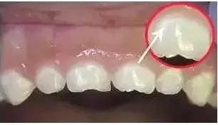 牙齿上出现白斑是怎么回事,牙齿上有白斑是什么原因