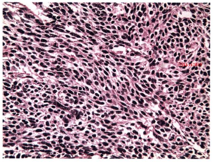 小细胞肺癌是指小结节吗,小细胞肺癌是肺细胞癌变吗