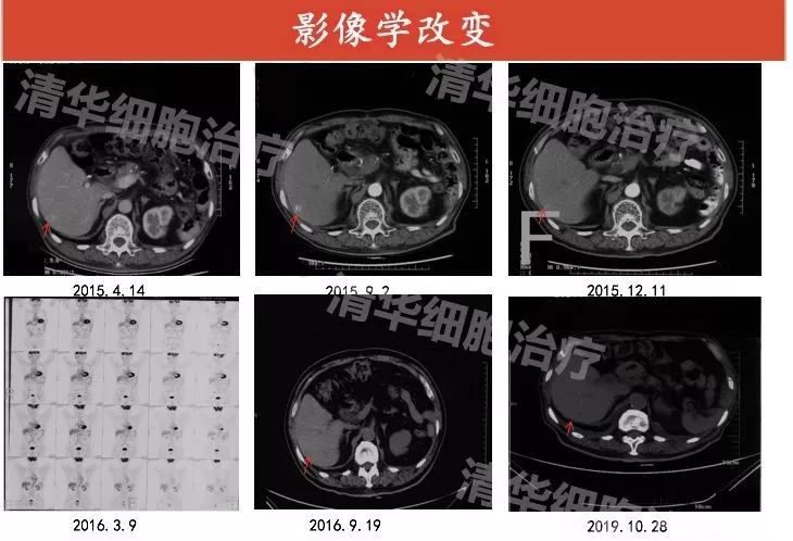 胰腺癌免疫治疗最新消息,最新胰腺癌免疫疗法