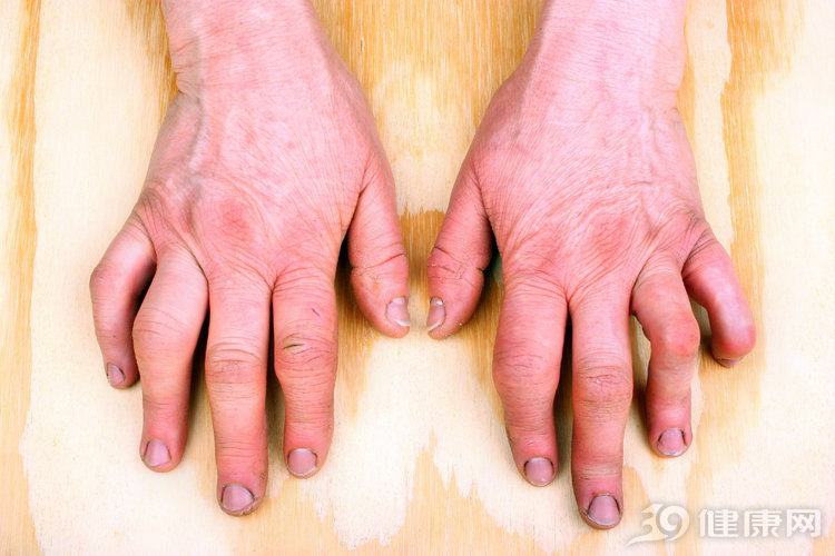 手指僵硬不灵活手指操,做手指操手僵硬怎么回事