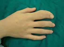 婴儿脉管畸形的最佳治疗方法,动静脉畸形怎么治疗好