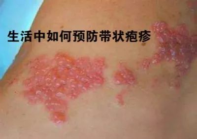 老年人怎么样预防带状疱疹,经常晒太阳预防带状疱疹