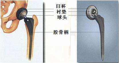 真实有效治疗骨折的方法,这几种骨折一定要注意