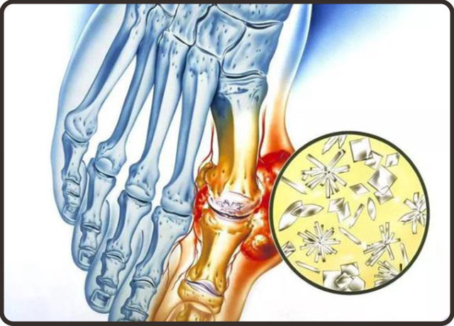 了解痛风性关节炎是怎样引起的,怎么样治疗痛风预防痛风最好