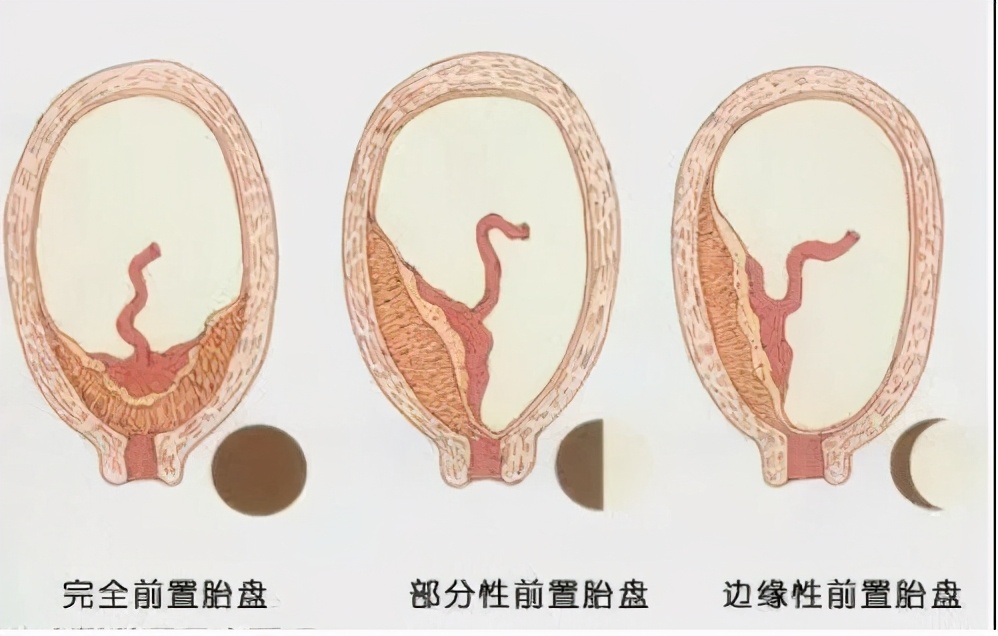 胎盘位置到底怎么看？