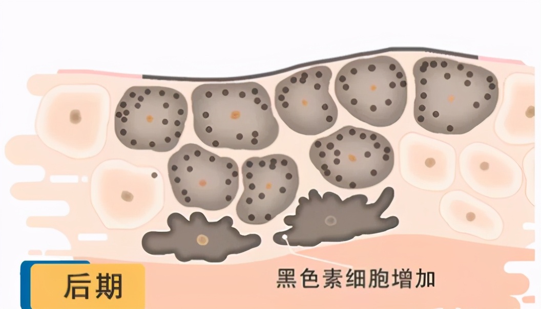 青褐斑激光治疗后颜色会加深吗,激光可以淡化褐斑吗