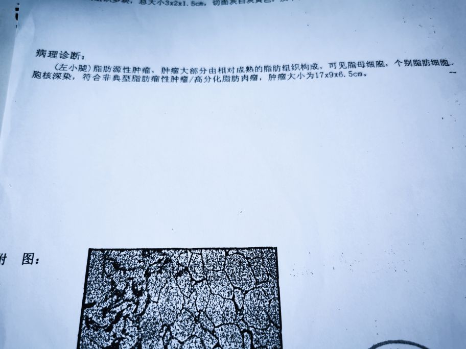 脂肪肉瘤和脂肪瘤怎么分辨,脂肪瘤很常见吗