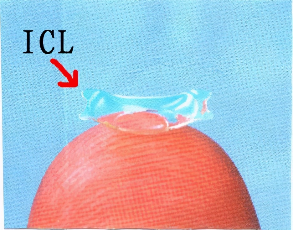 做半飞秒近视眼手术最坏的后果,近视眼手术最佳年龄和度数费用