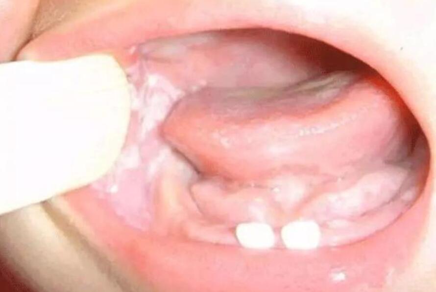 六个月宝宝嘴里面粘膜有白色点点,宝宝嘴巴里有一层白白的擦不掉