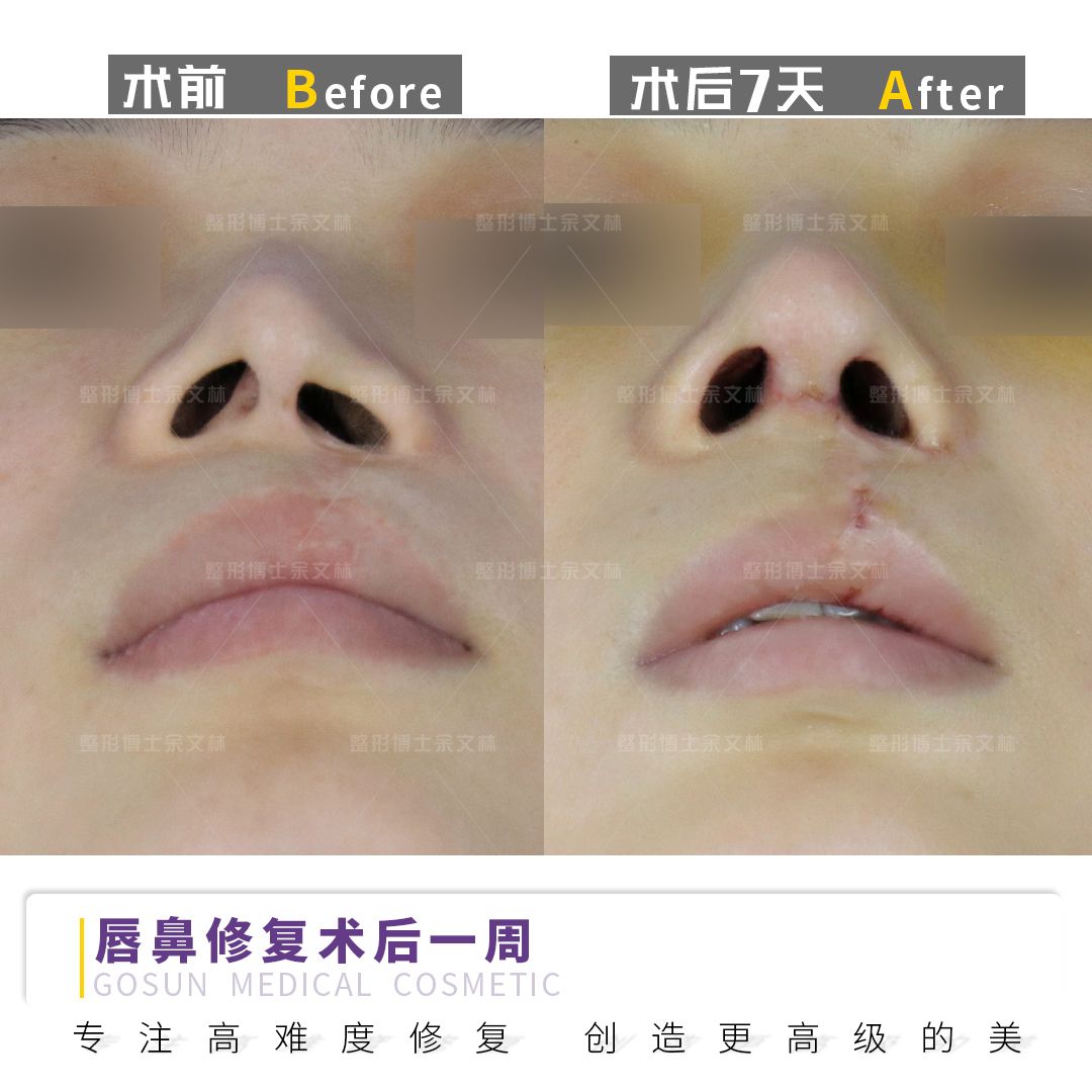 余文林博士修复唇裂多少年了,余文林唇裂二期修复大概多少钱