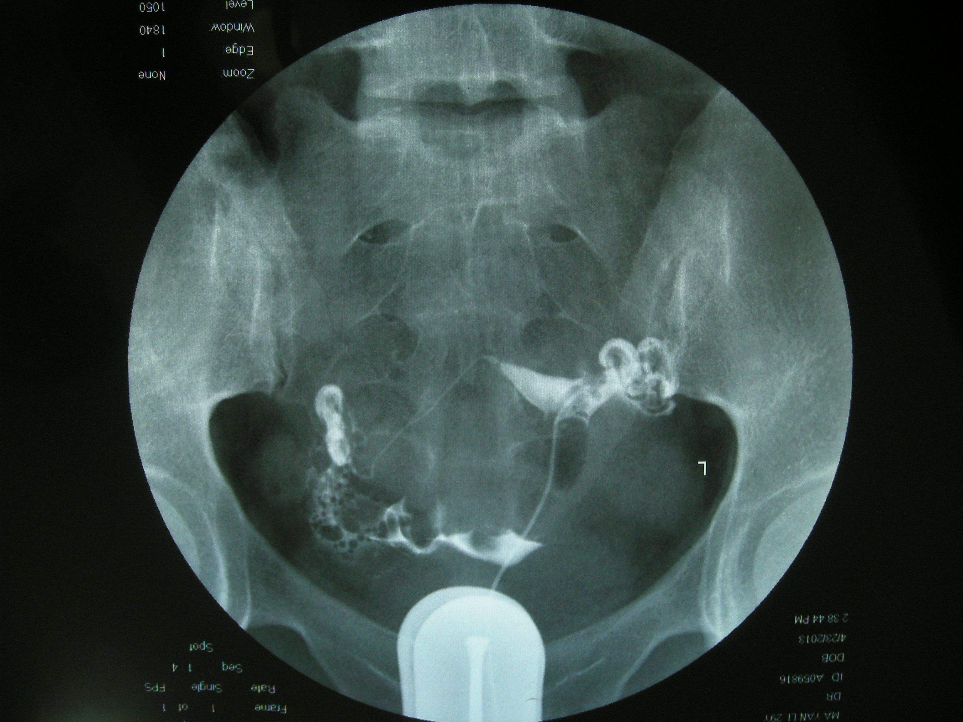 4步讲解输卵管造影检查过程