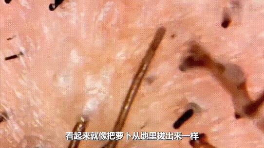 强行把头发拔下来会怎么样,硬生生拔掉的头发还能长么