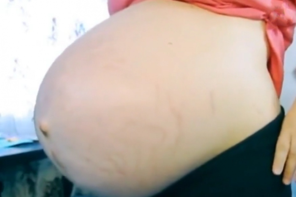 剖腹产手术有多疼,剖腹产术后有多疼