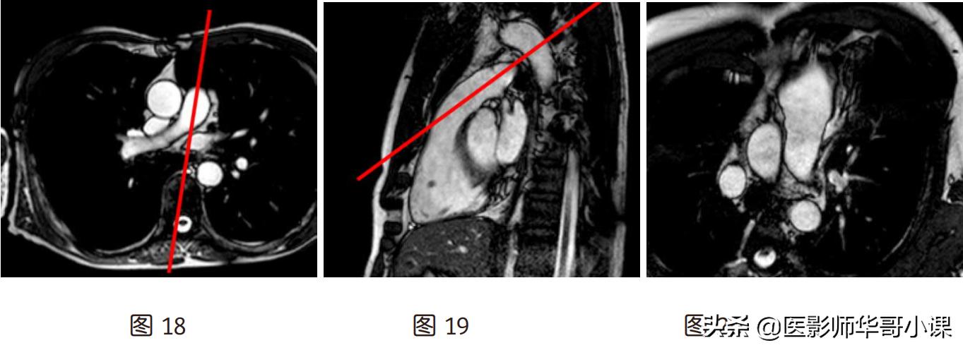 心脏mr增强扫描讲解,磁共振心脏扫描标准切面