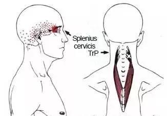 偏头痛的部位是哪里,偏头痛的原始痛点