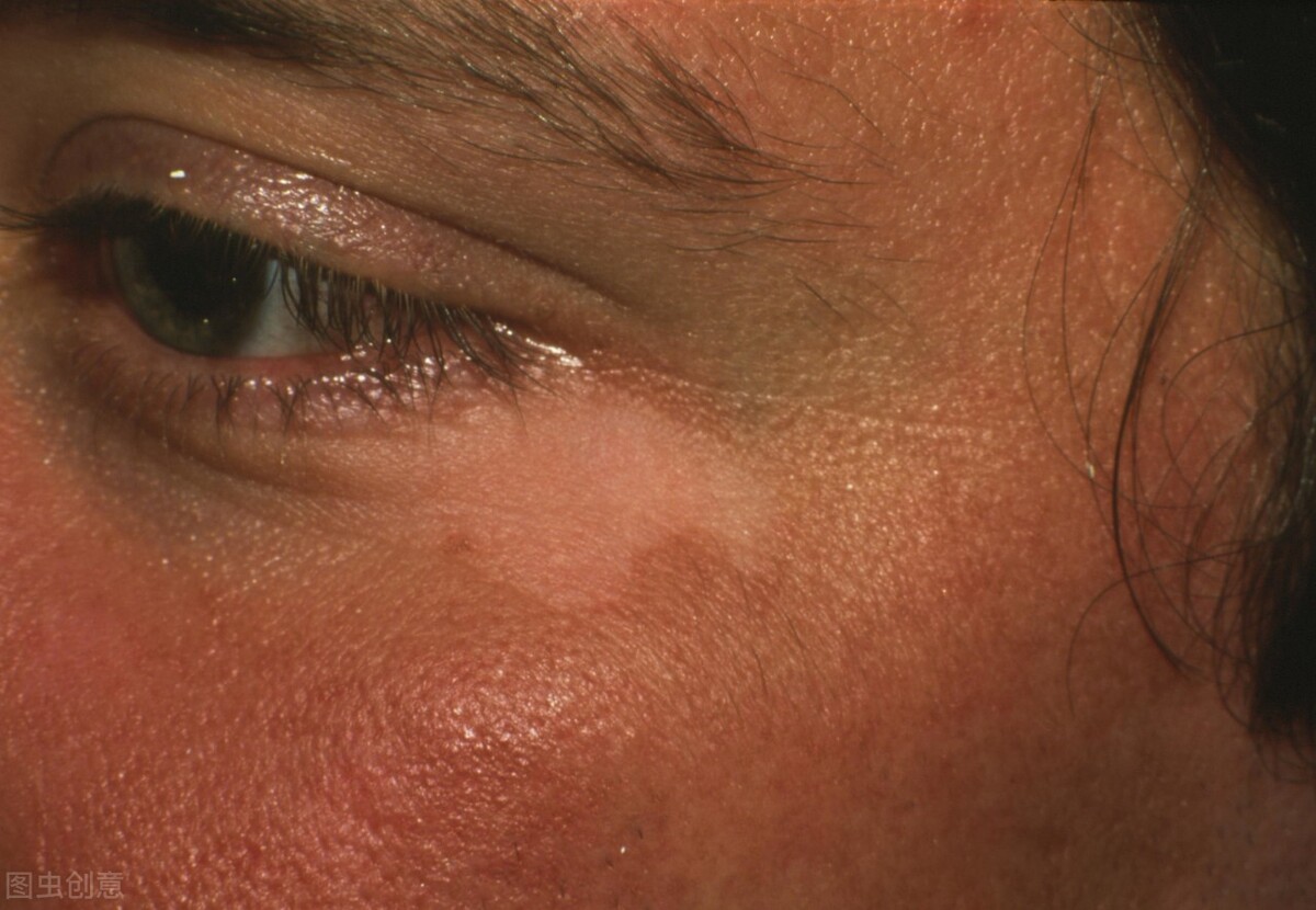 腹部白癜风扩散几率,如何防止白癜风扩散