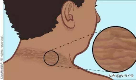 胖人脖子黑是糖尿病前兆吗,脖子黑洗不下来是糖尿病的前兆吗