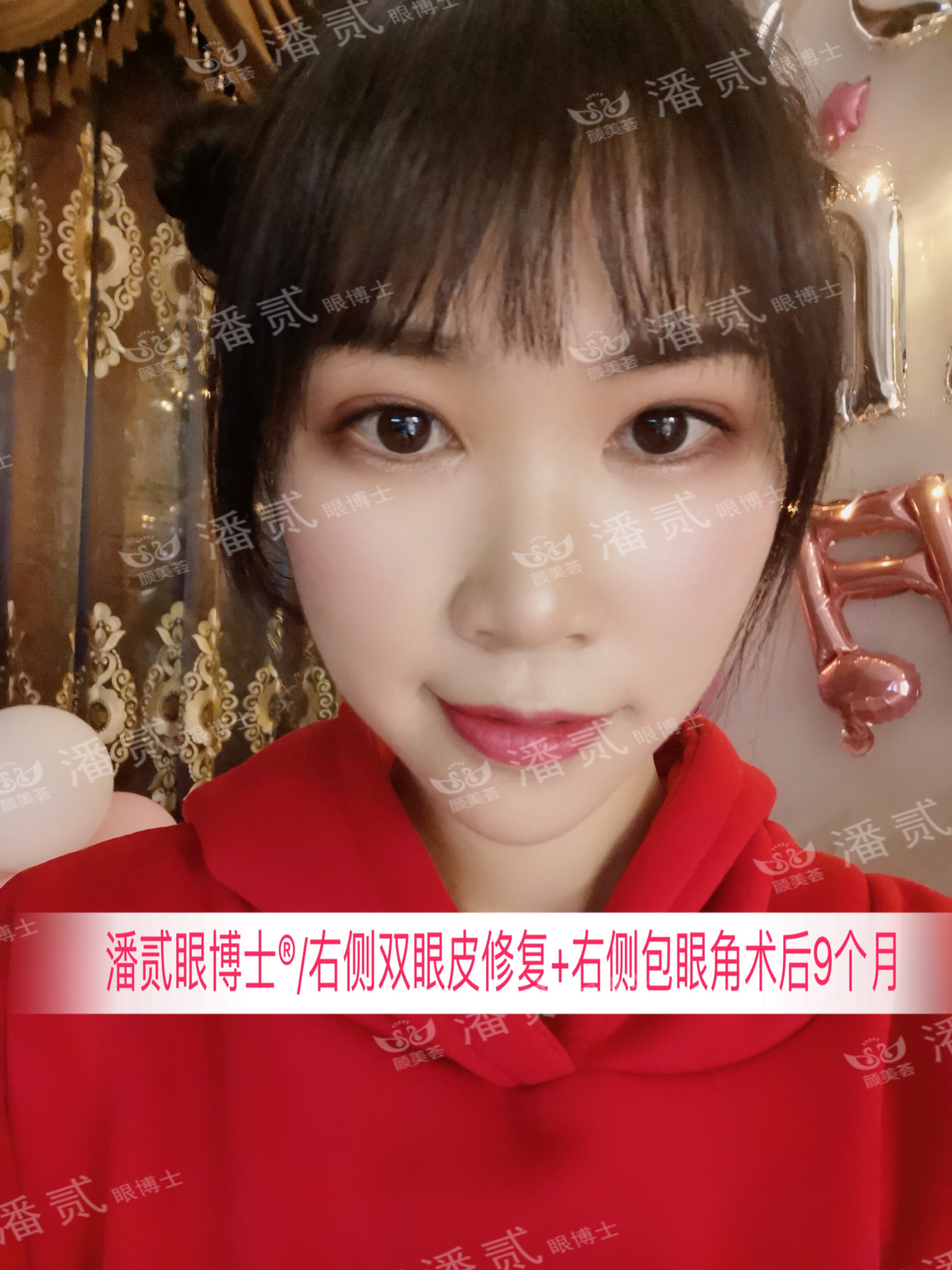 开内眼角会留疤的照片,开内眼角的疤痕变白色了怎么办