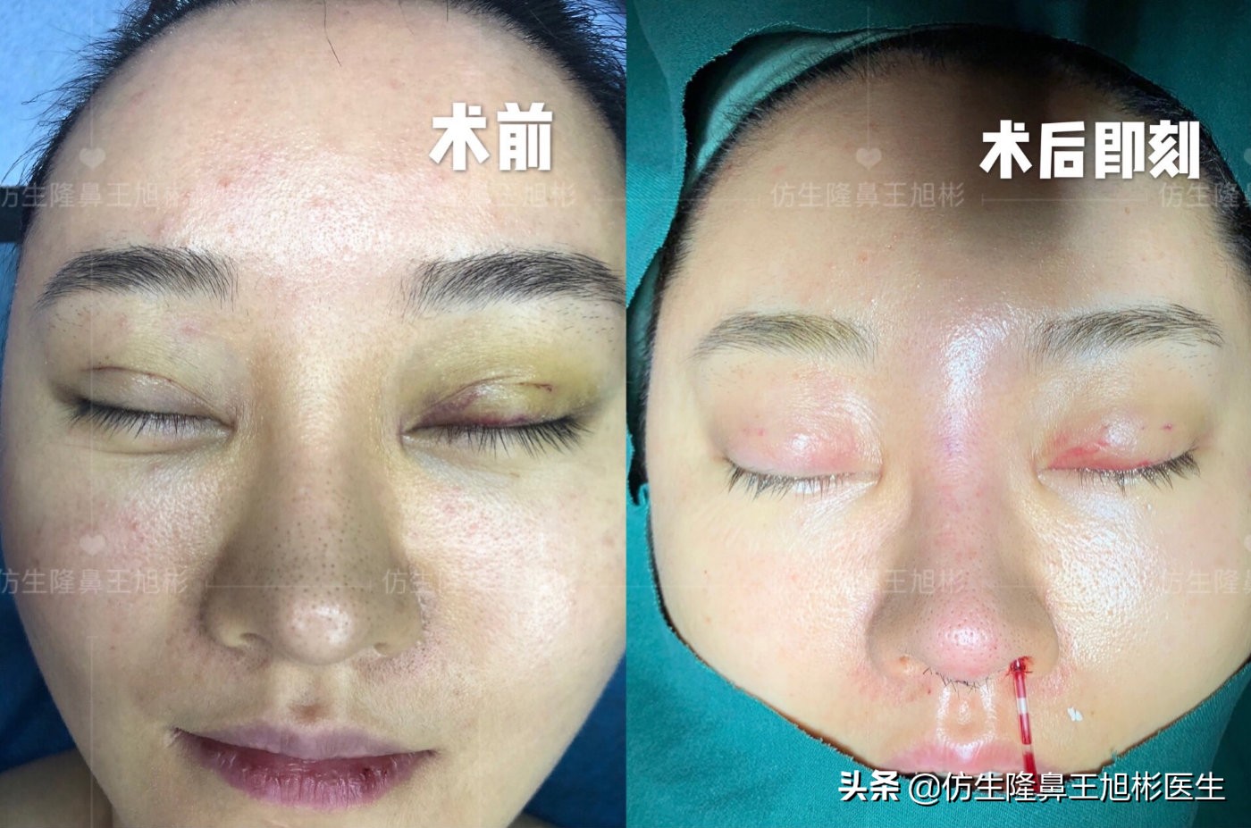 外切缩鼻翼的后遗症,外切鼻翼缩小会回弹吗