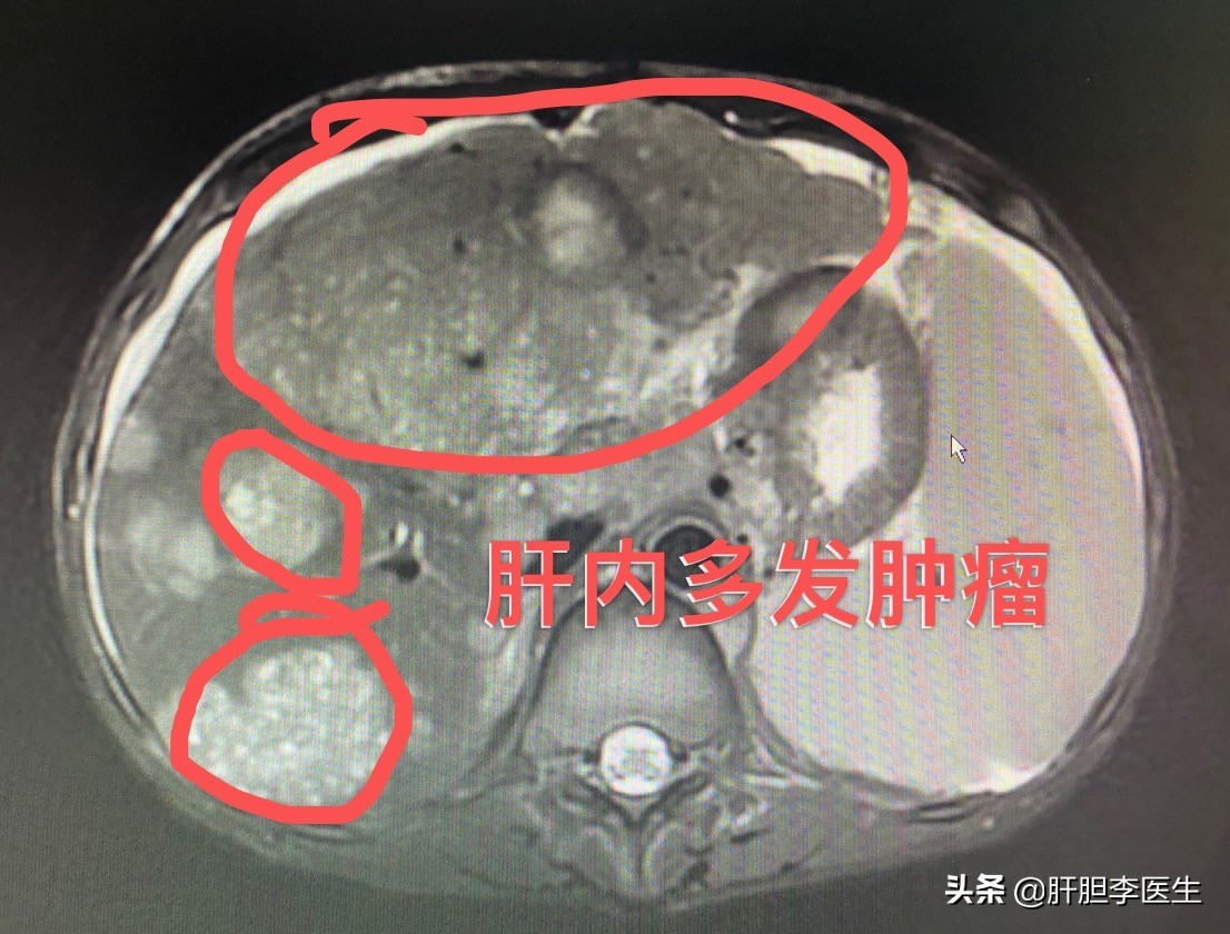 肝癌晚期的症状表现能活多久,肝癌晚期的6个表现腹部疼痛