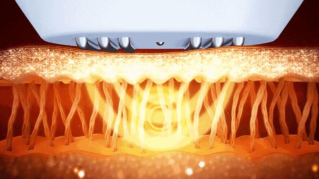 皱纹老化下垂怎么办,眼皮松弛下垂皱纹多最好解决方法