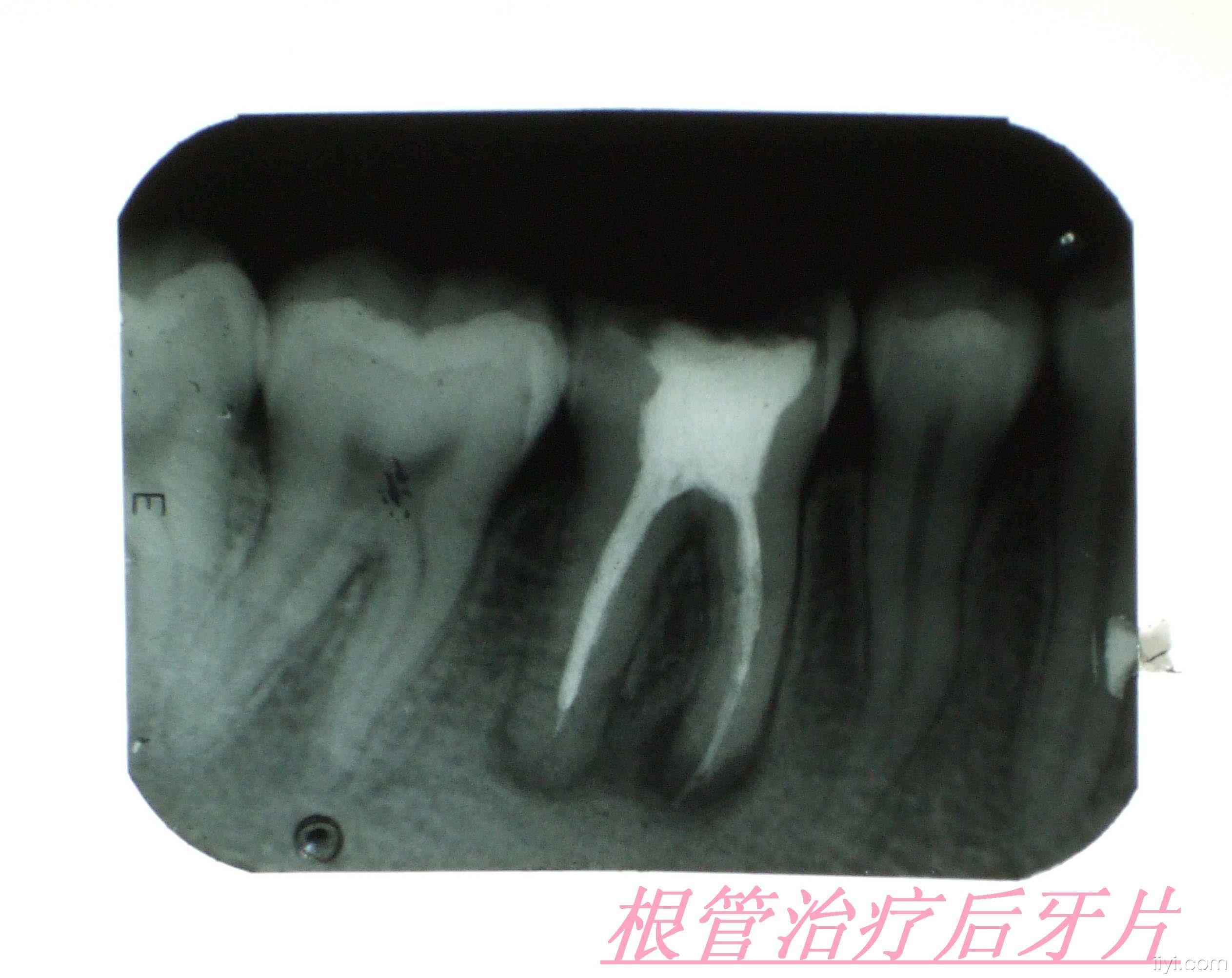 牙神经杀掉后再抽牙神经还会疼吗,抽过牙神经的牙齿是不结实了吗