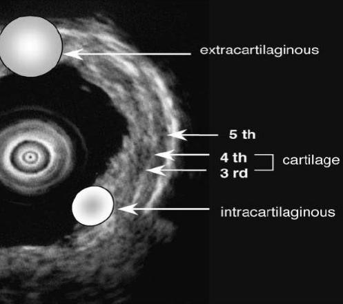 小细胞肺癌的气管镜介入治疗,导航支气管镜在肺癌诊断中的应用