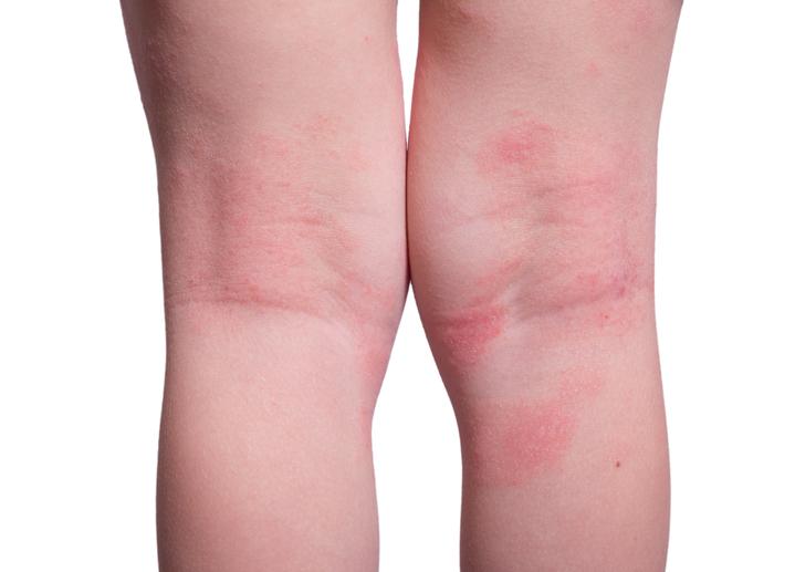 皮肤又红又痒又肿是什么原因,皮肤一抓就红而且凸起还痒怎么办