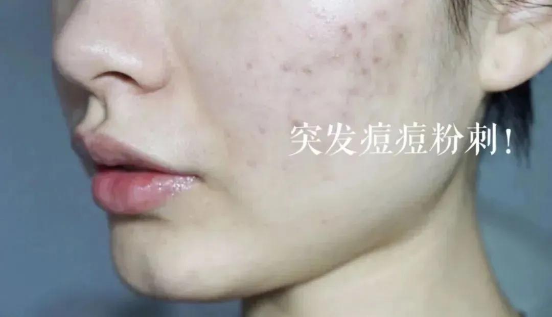 冻干祛痘面膜推荐,适合祛红痘印的面膜推荐