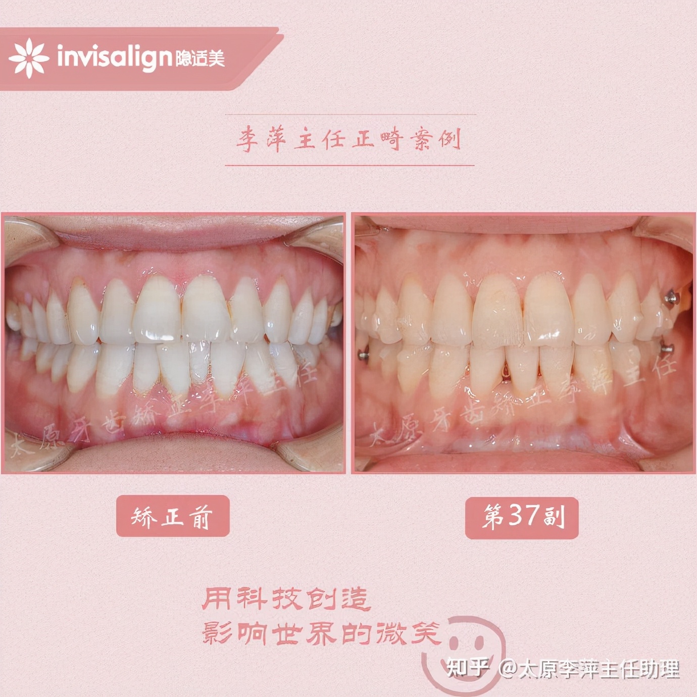 重度拥挤矫正牙齿适合隐形牙套吗,广州成人牙齿矫正推荐隐形牙套