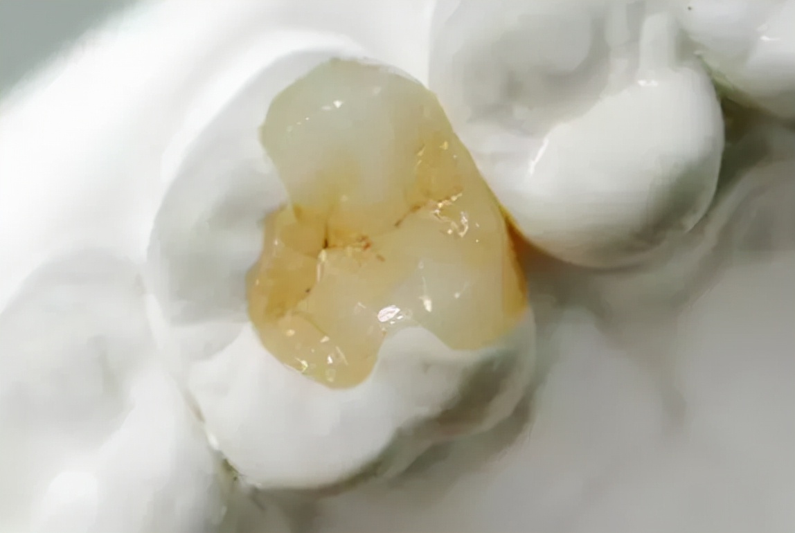 牙疼补牙的流程及步骤,补牙牙痛最好在哪里治疗