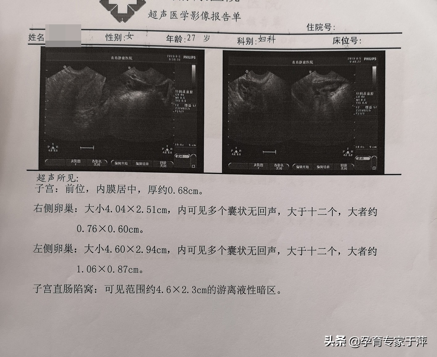 青岛助孕专家于萍：输卵管不孕、多囊，综合治疗喜怀孕