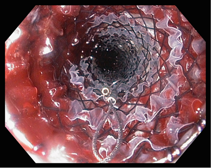 肠癌晚期腹腔转移肠梗阻如何造口,肠癌引起肠梗阻能治愈吗