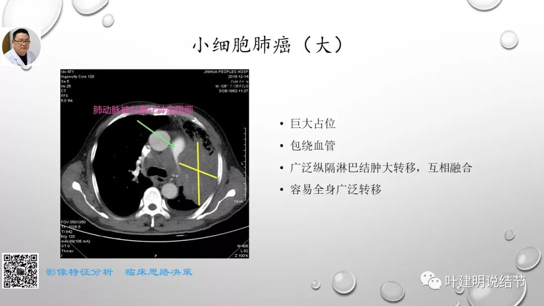 叶建明谈肺实性小结节视频,廖正银教授谈肺结节