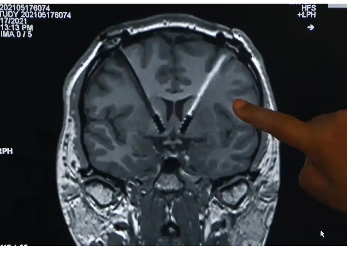 毒瘾治疗失败了。脑部手术能救他吗？