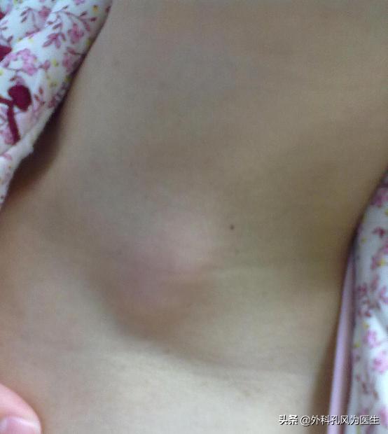 脖子老鼠疮,脖子上长老鼠疮图案