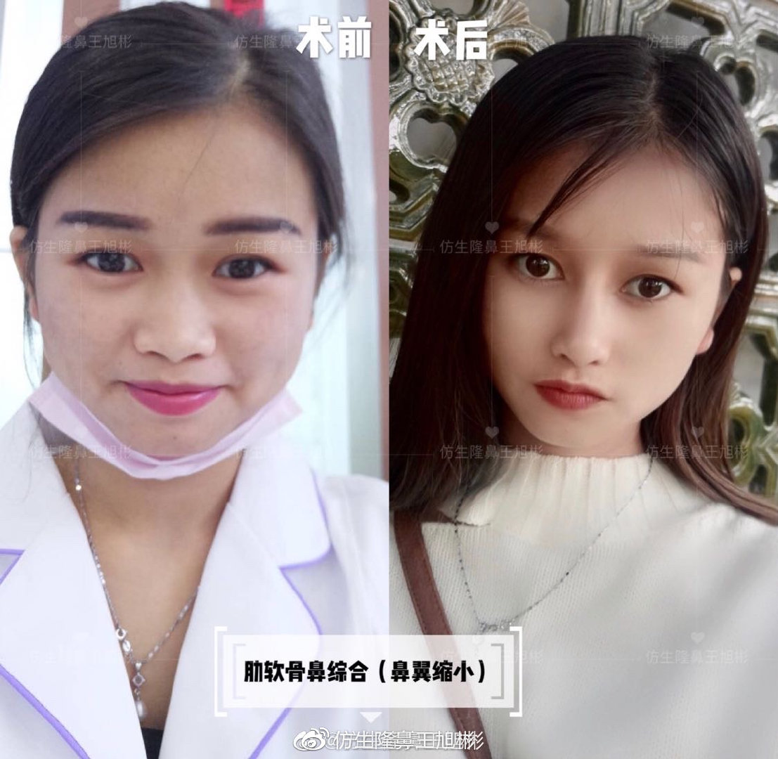 短鼻蒜头鼻整形,短鼻延长术切口