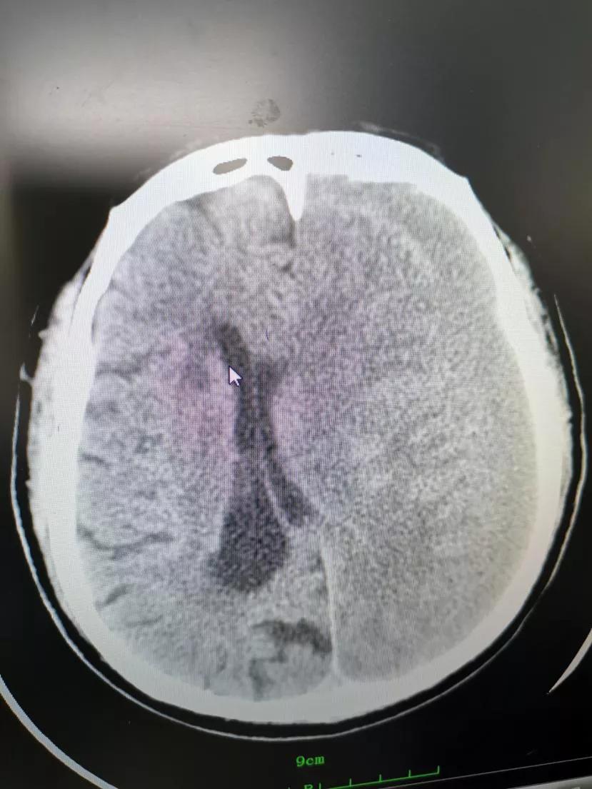 鎽斿埌鑴戣褰撳満娌′簨鍑犱釜鏈堝悗鐤肩棝,澶存憯鍒板綋鏃舵病浜嬩竴骞村悗浼氭湁浜嬪悧