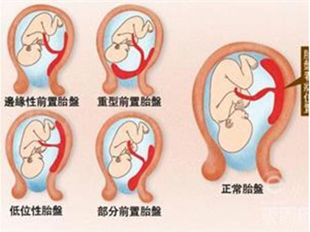 胎盘前壁怀孕剖腹产危险吗,胎盘前壁下怀早产几率大吗