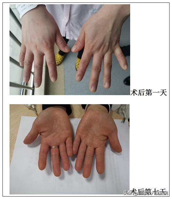 手心出汗是虚吗,手心出汗却不冰凉是怎么回事