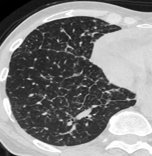 间质性肺疾病看病经验分享,分享肺腺癌临床实验的例子