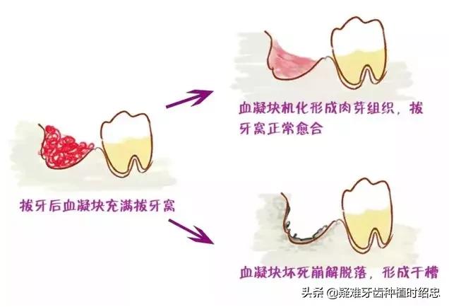 拔智齿的危险性和注意事项,拔智齿的危险和注意事项