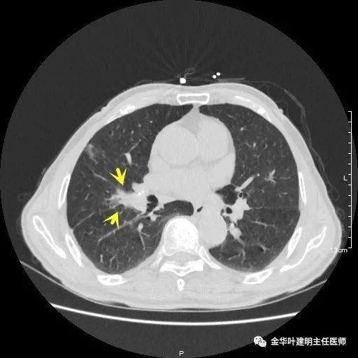 多发原发肺癌能根治吗,肺部原发性恶性肿瘤好治