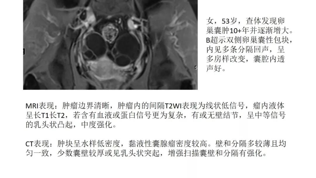 卵巢原发肿瘤的分析思路