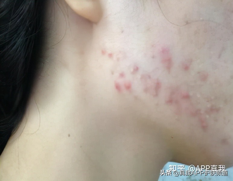 医院刷完水杨酸后注意事项,刷水杨酸棉片注意事项